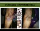 How to treat Psoriasis with Ayurveda .