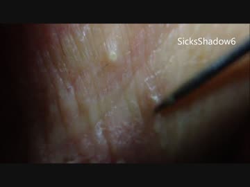 無限プチプチくん潰し(ニキビ)