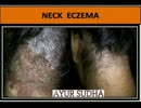 Chronic Eczema treatment in jalandhar