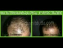 Hair disorder treatment in punjab