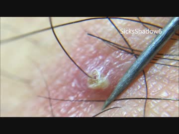 毛穴ニキビを毛ごと抜き潰すパート8ニュル