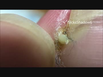 バレンタインだし巻き爪ホワイトチョコ(膿)しぼり！！前