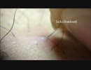 毛穴ニキビに埋まってる毛が予想以上に長くてワロタｗｗｗ