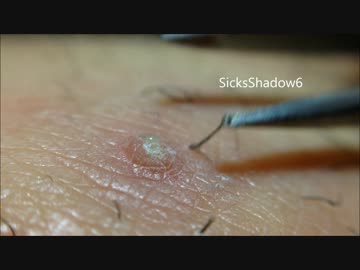 ニキビ膿と一緒にプルプル毛根が出てきてワロタｗｗｗ