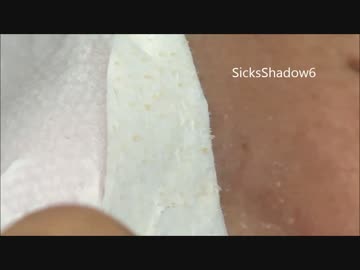 すっきり角栓祭り！！！鼻パックンギモッチイイ！