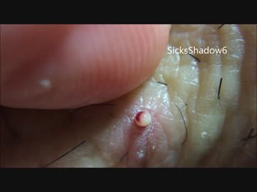 かさぶたと思って油断したら膿がニュルっと生み出た件！前