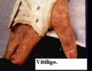 Michael Jackson and Vitiligo（尋常性白斑）
