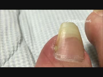 ポルナレフみたいな巻き爪から膿がニュルルッ！【1日目】