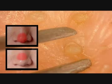 #27 角栓を連続で押し出してみた