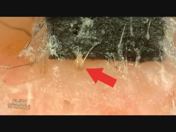 角栓が回った！これはすごい(棒