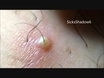 毛穴ニキビを毛ごと抜き潰すパート14(撮影失敗)