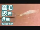 #3 産毛抜き(角栓とプチ毛根鞘もあるよ