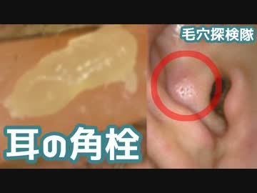 耳の角栓を押したり抜いたりしてみた(皮脂もすごい