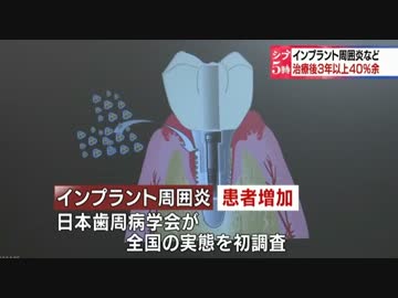 インプラント治療後３年以上 ４０％余にあごの骨の病気や炎症