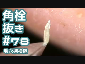 ＃78 低倍率で角栓抜いてみた