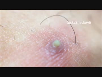 『パチッ☆』と音が鳴って潰れるニキビ 　音は100点　