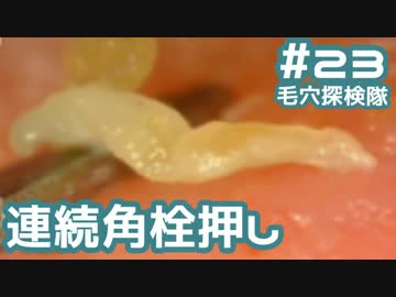 #23 角栓を連続で押し出してみた(200→150倍)