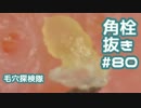 #80 角栓を200倍で抜いてみた(ポッカリ毛穴マニアあつまれ～