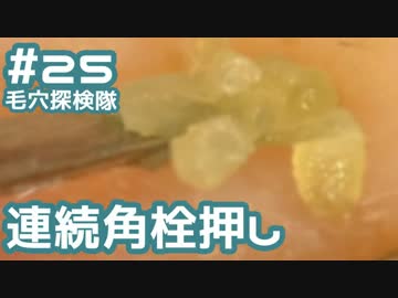 #23 角栓を連続で押し出してみた(150倍で大収穫