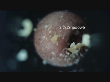 ＃２耳掃除 でかい耳垢の塊をマイクロスコープを使って取ってみた！