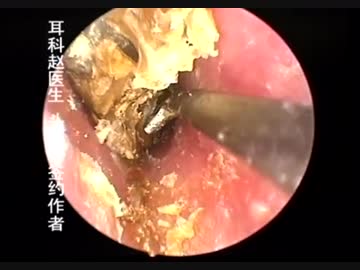 ホモと見る中国人の耳糞.mp4