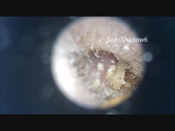 #3耳掃除 マイクロスコープで耳かき 耳垢の量がすごいｗ