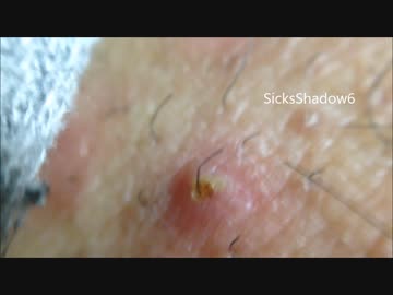 毛穴ニキビを毛ごと抜き潰すパート21