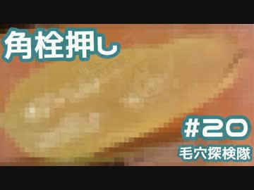 #20 角栓を200倍で押し出してみた