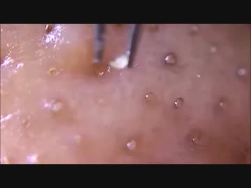 巨大な角栓をすっぽり抜いてみた その３ ニコニコ動画