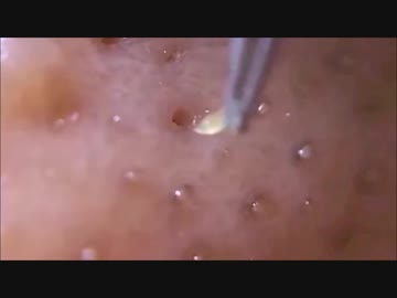 巨大な角栓をマッハでスポスポしてみた ニコニコ動画