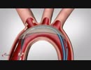 Cerebral Embolic Protection - Keystoneheart.com