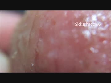 指にプツプツ水疱が大量に犇めいてて草ァ！ シーズン4