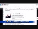 イタリア人医師と中国が人体頭部移植に初成功で非難殺到20171123