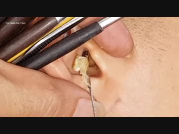 ベトナムの耳掃除を一時間鑑賞