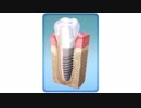 Best Dental Implants in Palmdale | 661-722-7722