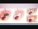 Surgical Treatment For Endometriosis | 212-988-1444