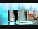Fracture treatment in Coimbatore