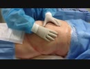 お腹の脂肪を2600ml除去！脂肪吸引で叶える理想の体／ 大橋Dr