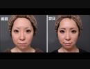 【頬・顎の脂肪吸引】術後のダウンタイムは？  ｜執刀医：福田 越Dr.