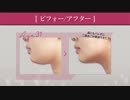 顔（頬・顎）の脂肪吸引で二重顎を改善!【症例画像あり】