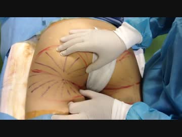 【脂肪吸引で失敗】お尻のたるみをサーミタイトで修正/Dr.大橋