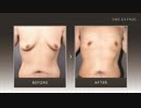 【女性化乳房】男性が受けた胸の脂肪吸引｜女性のような胸が男性的に