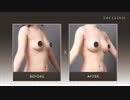 脂肪注入豊胸でバストアップ!｜症例写真