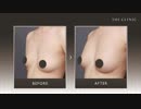 【授乳を終えた方の豊胸】コンデンスリッチ豊胸の症例写真
