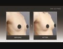 【自分の脂肪を使った豊胸】 脂肪注入豊胸の症例写真