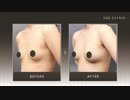脂肪注入豊胸のモニター症例をご紹介｜症例写真