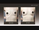 【驚きの定着率】脂肪注入豊胸の症例写真