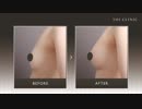 【豊胸の種類】脂肪注入豊胸をご存知ですか？｜症例写真