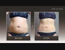 【ポッコリお腹がペタンコに!】女性の脂肪吸引を紹介します