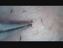 004 高倍率毛抜き Doctor tweezers Remove hair microscope 毛抜先生 닥터 족집게